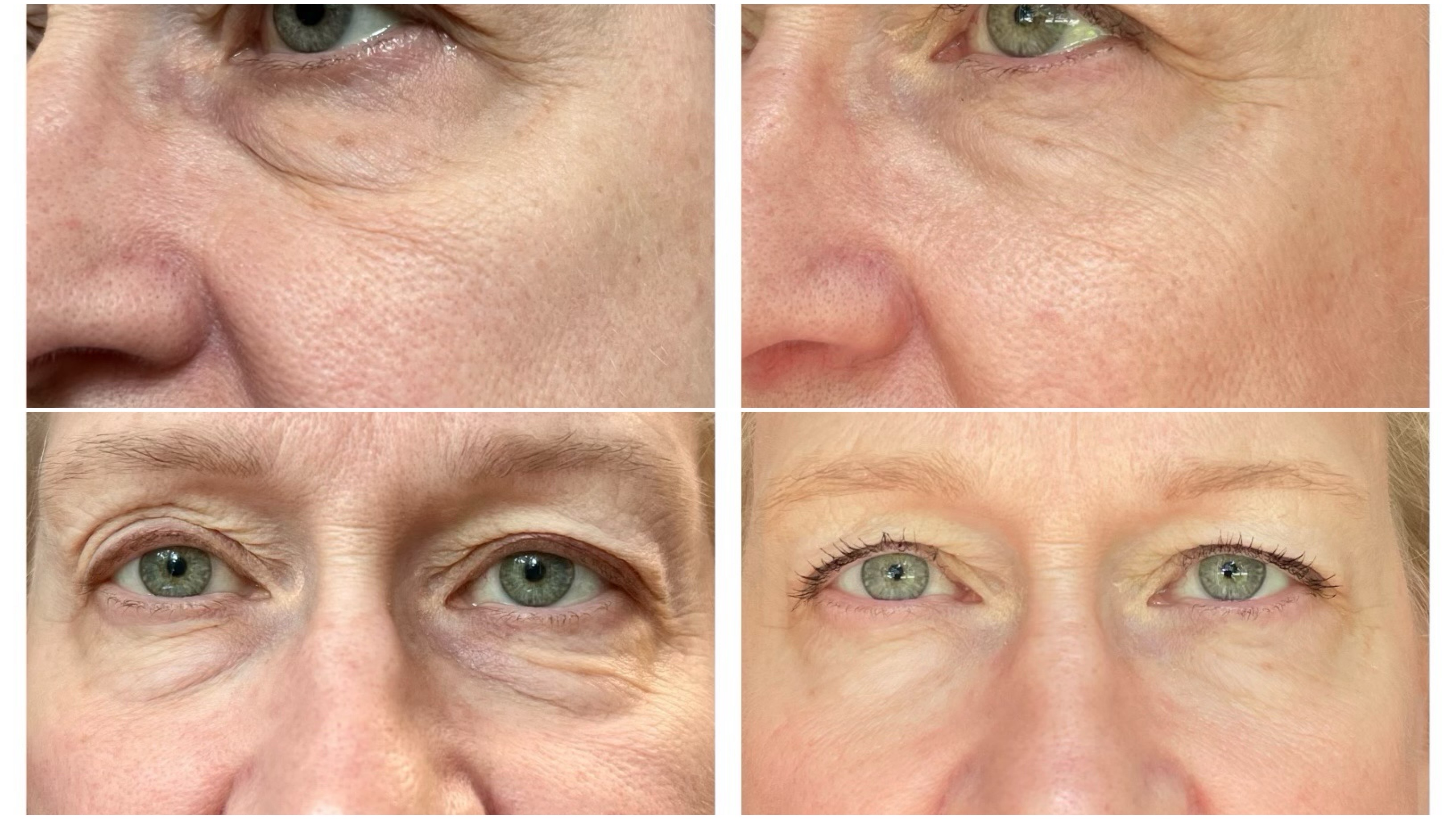 Before and after — Woman, Age 60, 90-day under-eye and crow's feet results