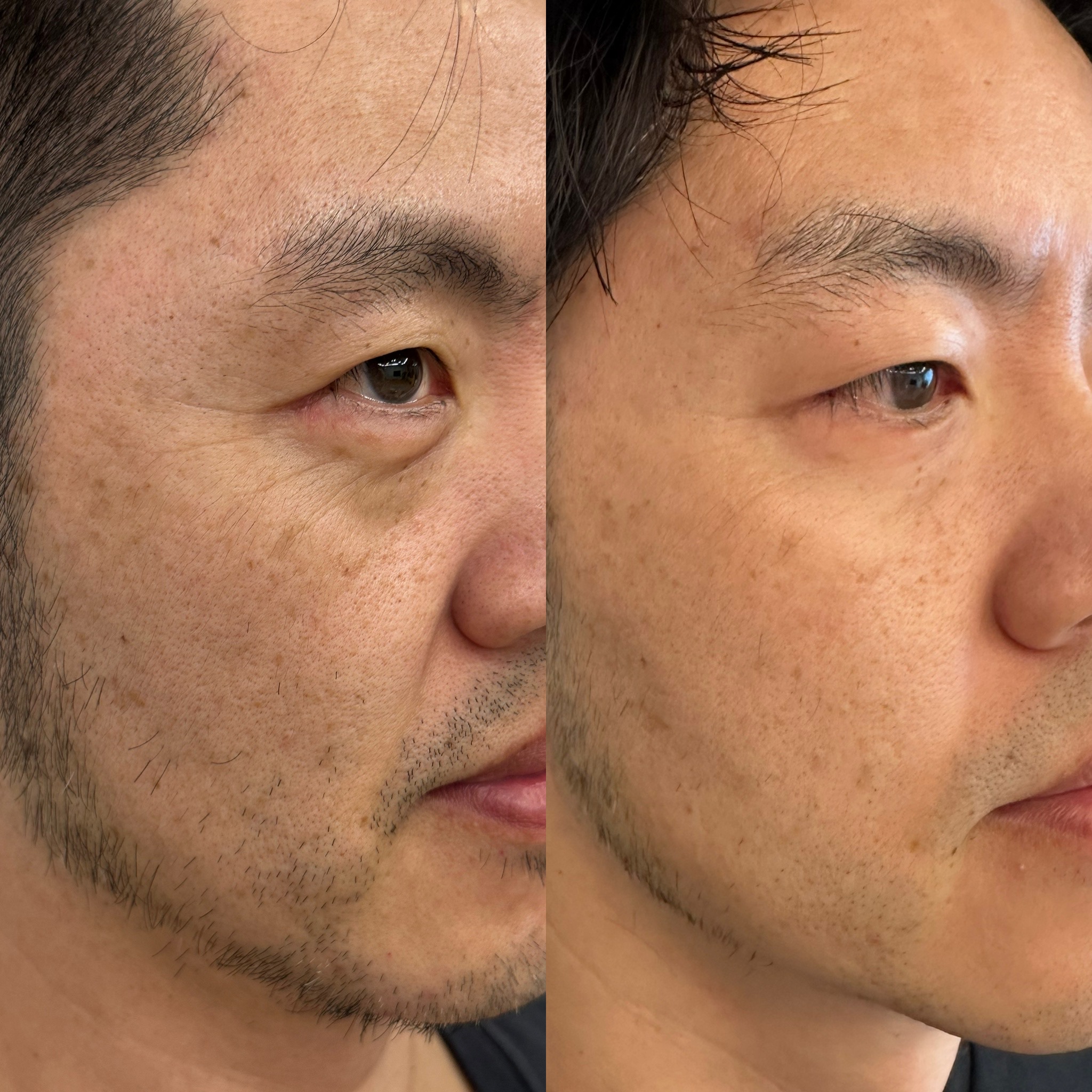 Before and after — Man, Late 30s, 90-day pore and clarity results