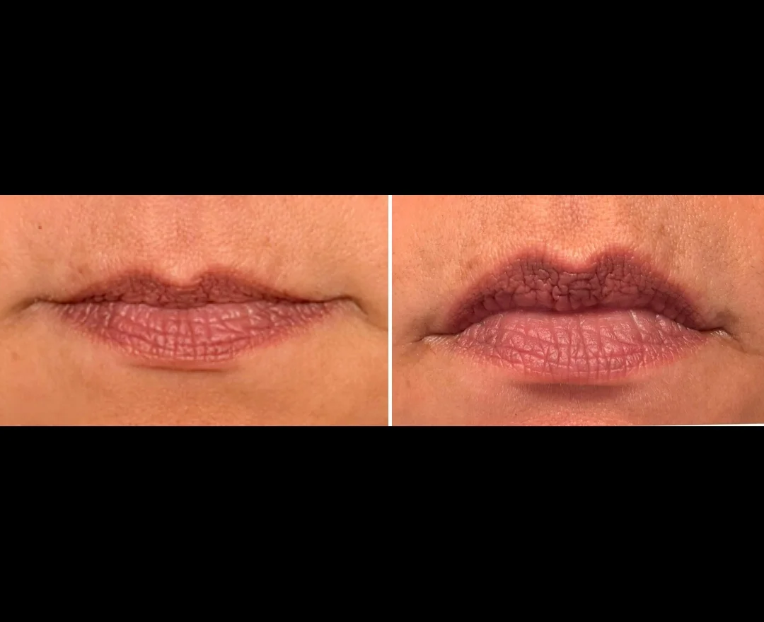 Before and after — lip volume, color, and texture results, woman in her 60s