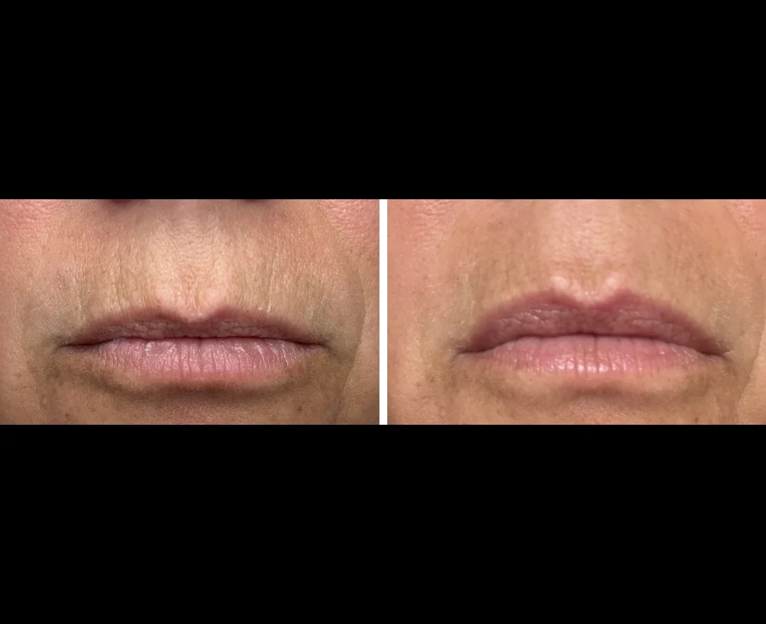 Before and after — lip line smoothing and definition results, profile view